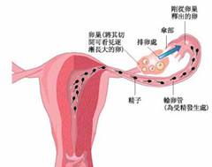 三维盆腔灌注，专业治疗盆腔炎